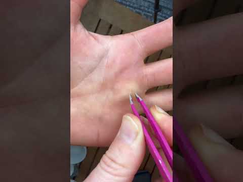 How to get a splinter out when tweezers don’t work #carpentry #diy #splinter #hack